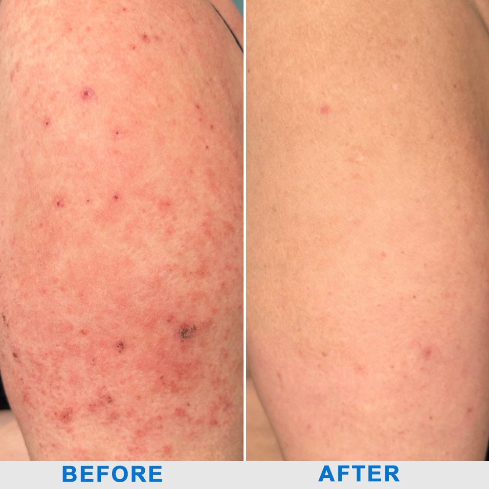 ODALIT™  OatCalm Skin Repair Cream Rx(Relieves eczema, itching , dermatitis, psoriasis, skin allergies,  pigmentation, dry skin, and other common skin issues)