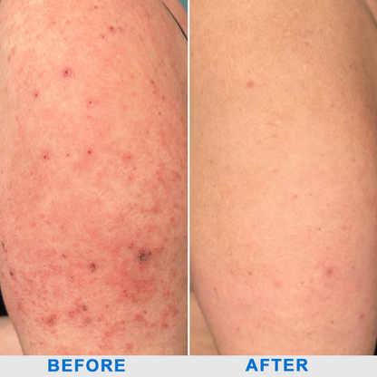 ODALIT™  OatCalm Skin Repair Cream Rx(Relieves eczema, itching , dermatitis, psoriasis, skin allergies,  pigmentation, dry skin, and other common skin issues)