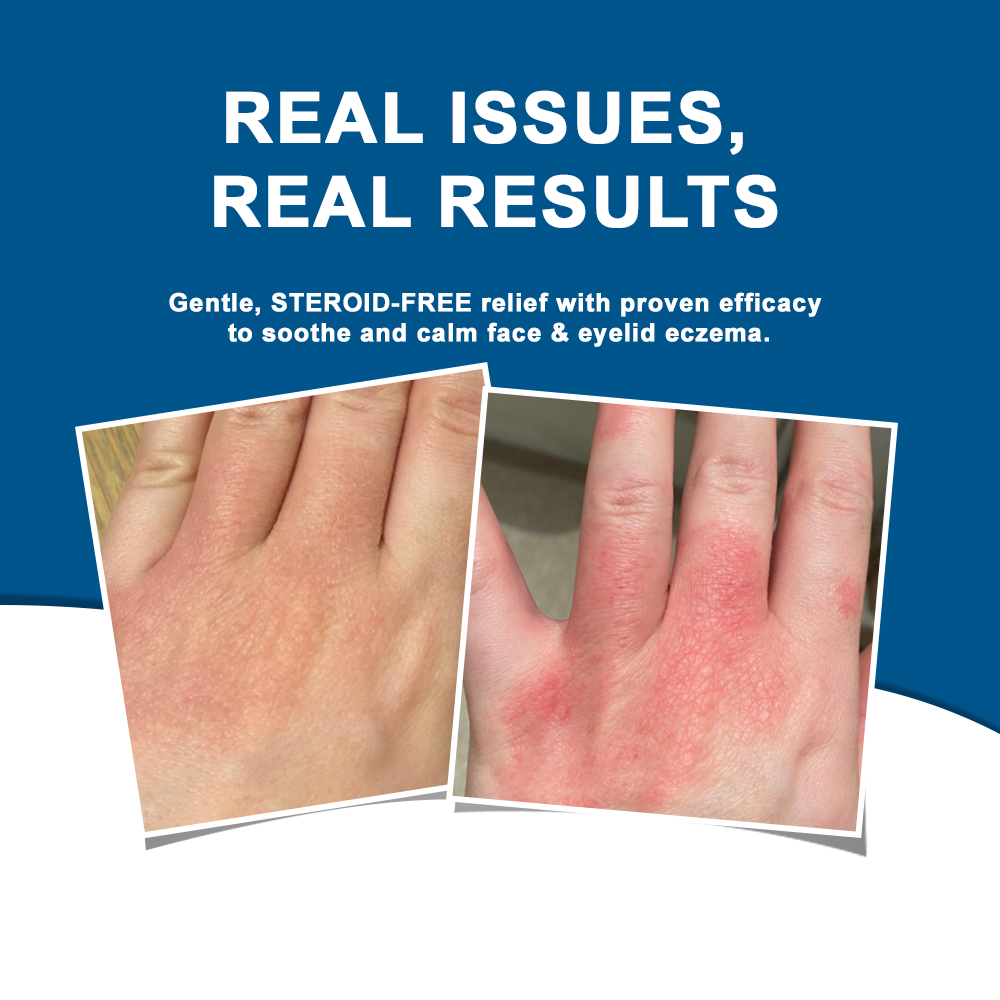 ODALIT™  OatCalm Skin Repair Cream Rx(Relieves eczema, itching , dermatitis, psoriasis, skin allergies,  pigmentation, dry skin, and other common skin issues)
