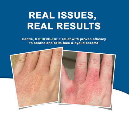 ODALIT™  OatCalm Skin Repair Cream Rx(Relieves eczema, itching , dermatitis, psoriasis, skin allergies,  pigmentation, dry skin, and other common skin issues)